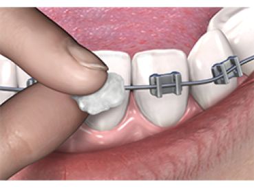 Cera ortodontica - singolo imballato