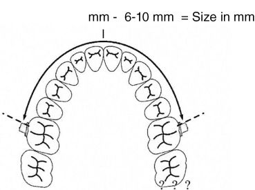 Arco di distalizzazione molare, misura 7 (98 mm)