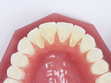Tip di ricambio per MiniMold Tiger Dental (morso palatinale)