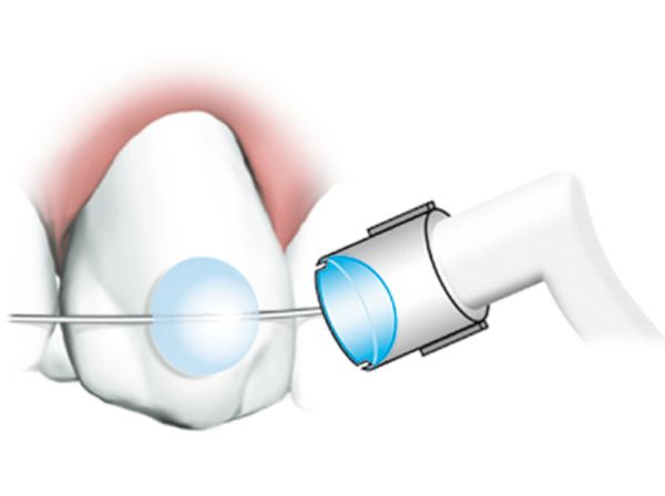 MiniMold System, rialzo dei molari
